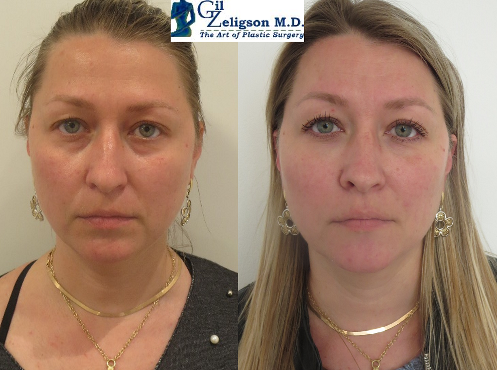 Dr. Gil Zeligson - Facial Sculpturing Hyaluronic acid