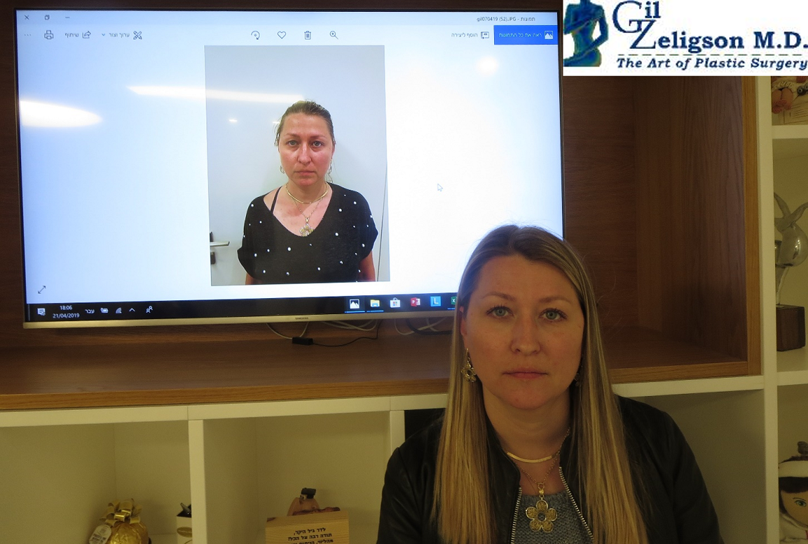 Dr. Gil Zeligson - Facial Sculpturing Hyaluronic acid