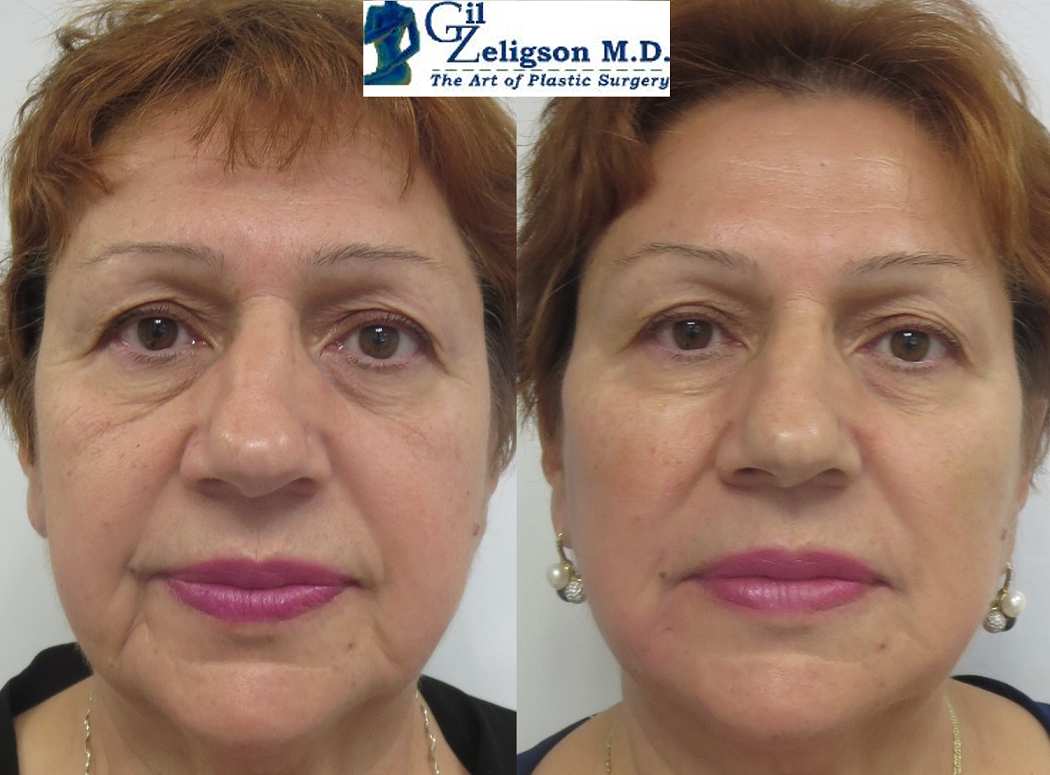 Dr. Gil Zeligson - Facial Sculpturing Hyaluronic acid