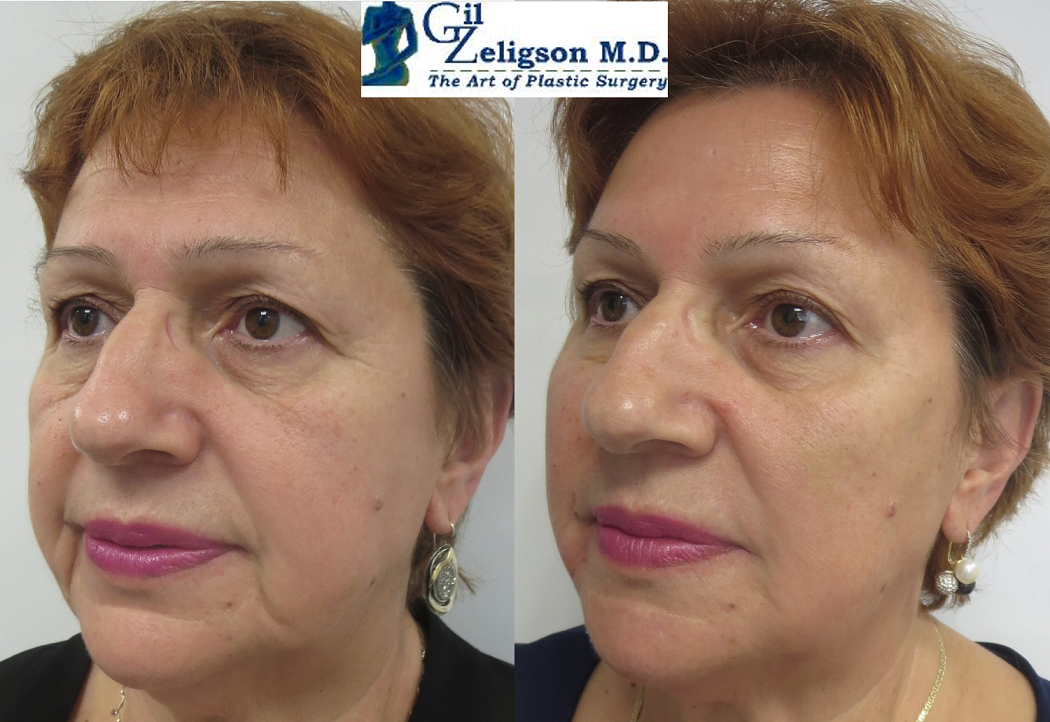 Dr. Gil Zeligson - Facial Sculpturing Hyaluronic acid