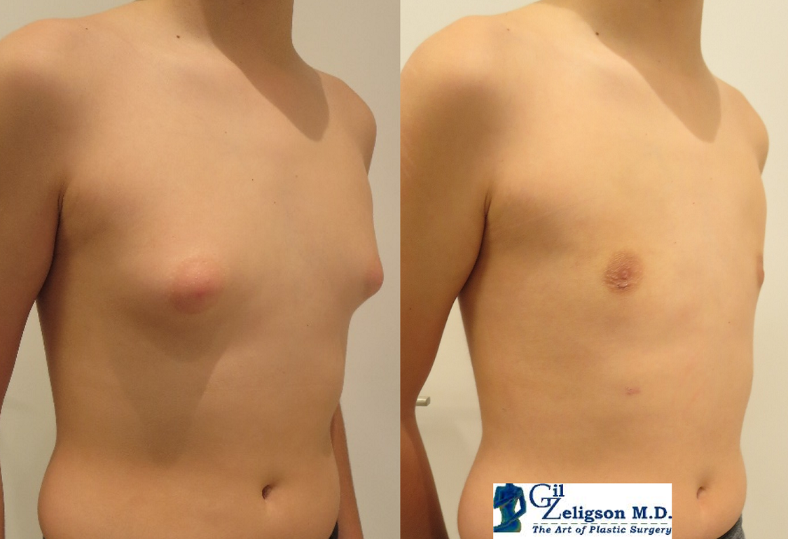 Dr. Gil Zeligson - Gynecomasty