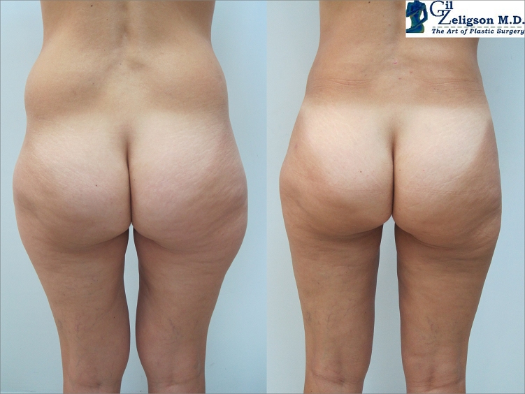 Dr. Gil Zeligson - Liposuction