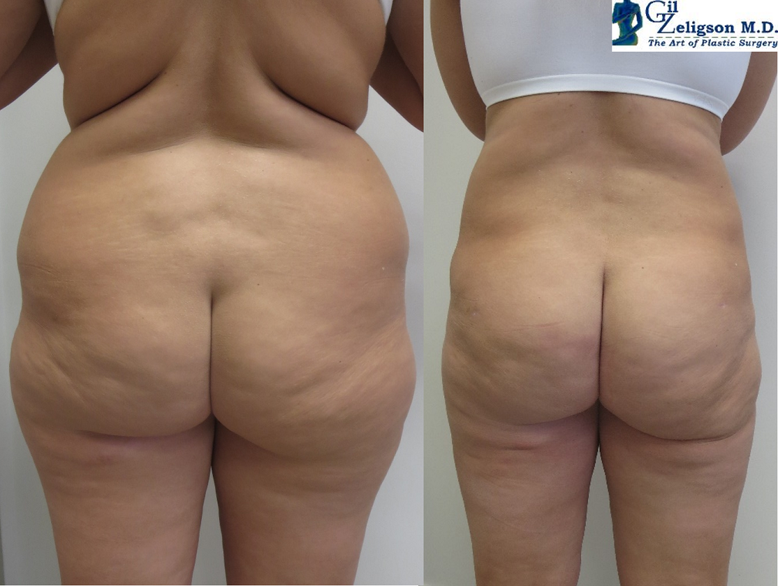 Dr. Gil Zeligson - Liposuction