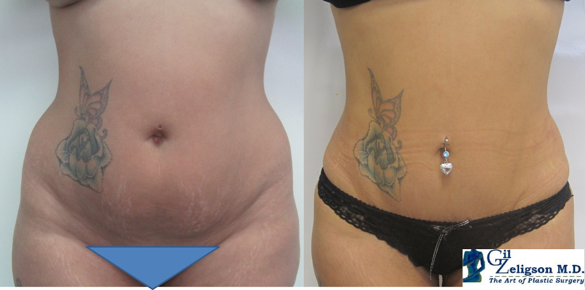 Dr. Gil Zeligson - Liposuction