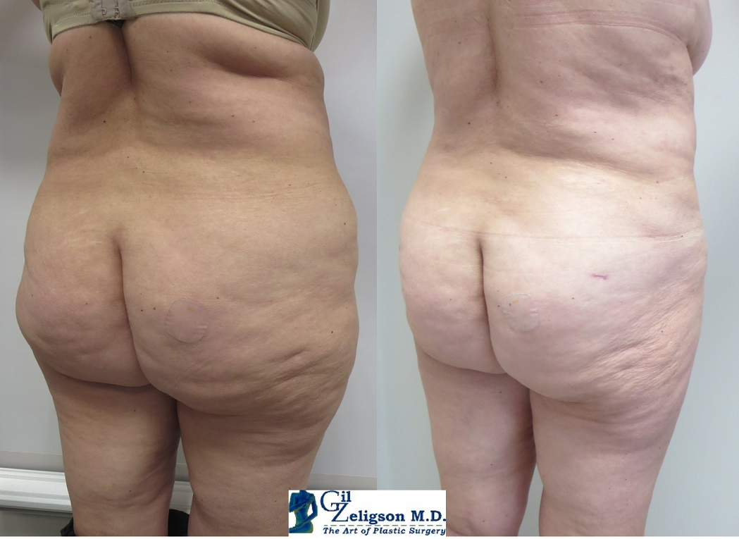 Dr. Gil Zeligson - Liposuction
