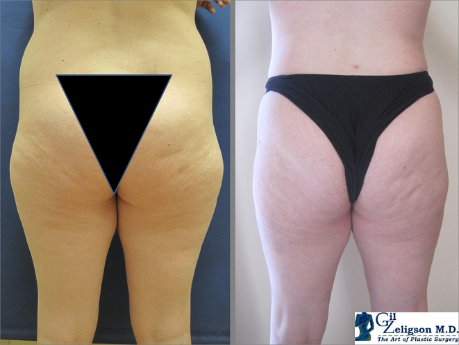 Dr. Gil Zeligson - Liposuction