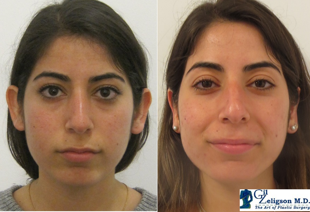 Dr. Gil Zeligson - Otoplasty