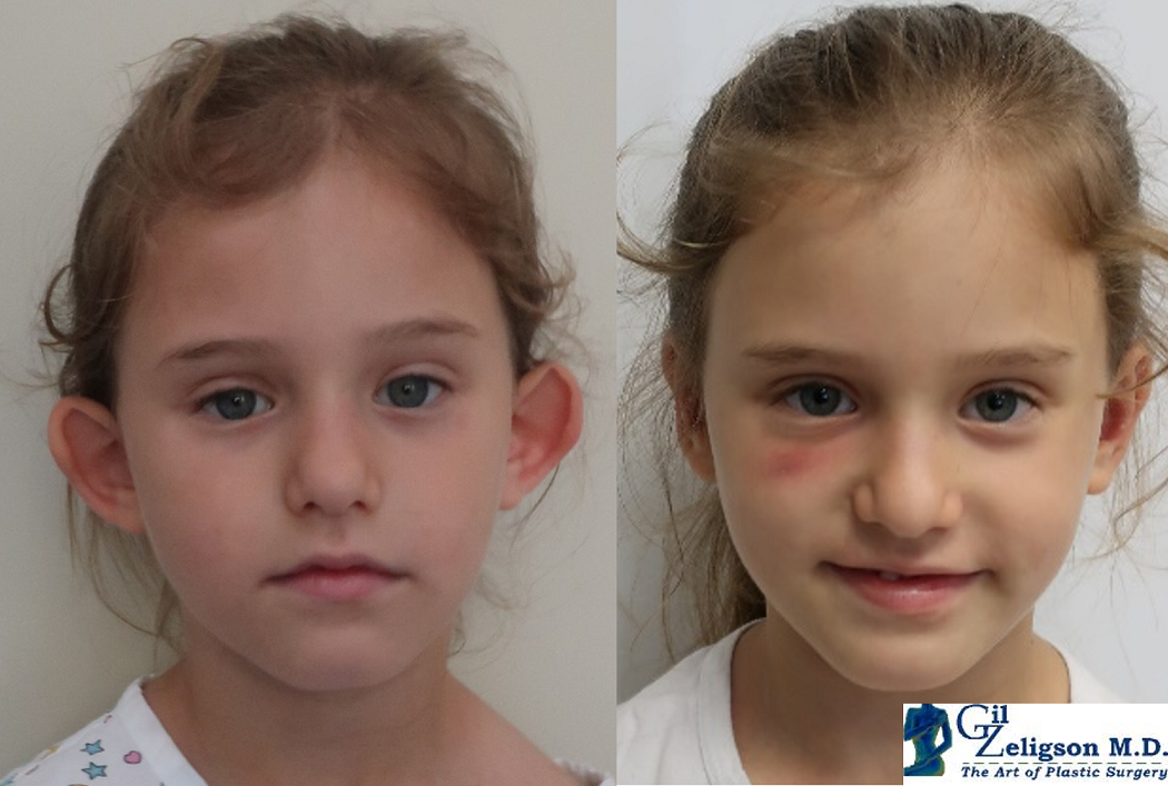Dr. Gil Zeligson - Otoplasty
