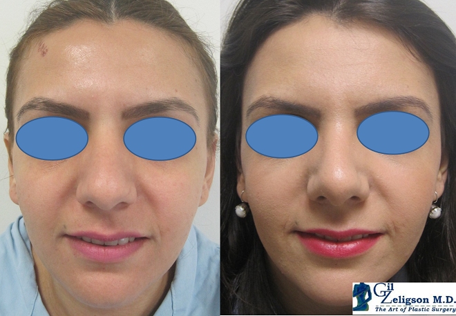 Dr. Gil Zeligson - Rhinoplasty