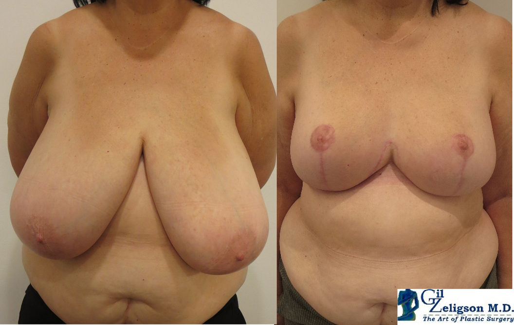 Dr. Gil Zeligson - Breast Reduction
