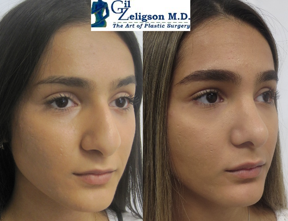 Dr. Gil Zeligson - Rhinoplasty