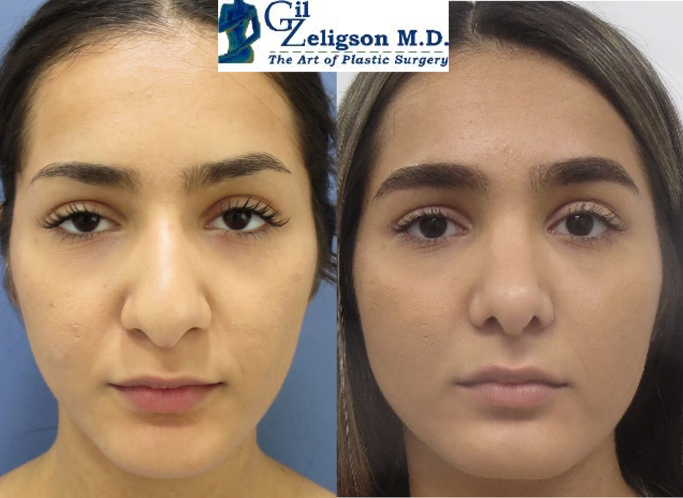 Dr. Gil Zeligson - Rhinoplasty