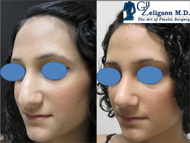Dr. Gil Zeligson - Rhinoplasty