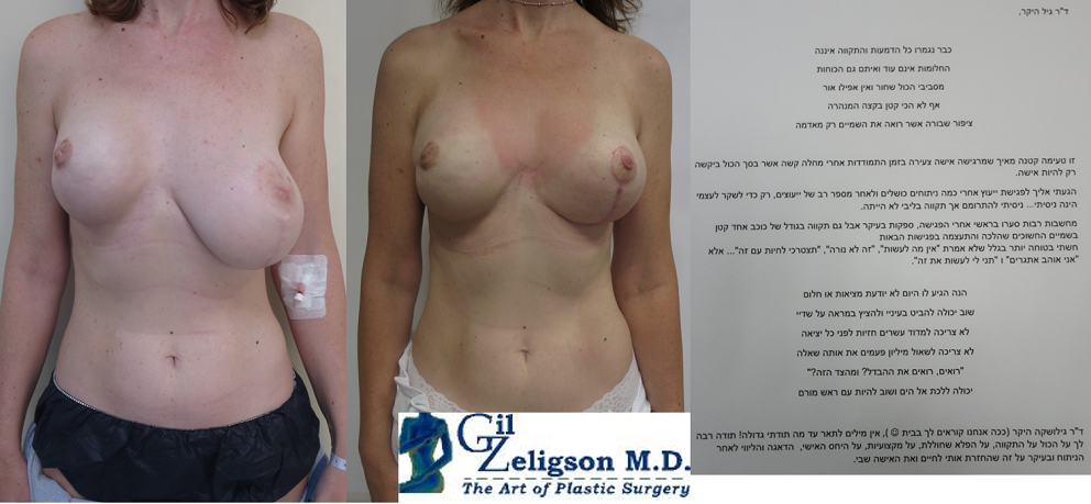Dr. Gil Zeligson - Breast Asymmetry Correction