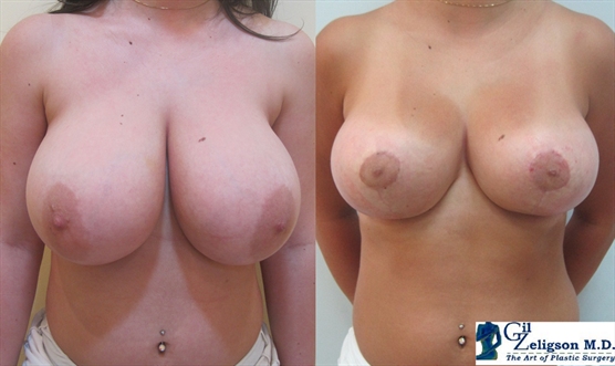Breast Reduction