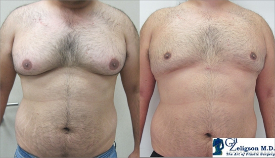 Gynecomasty
